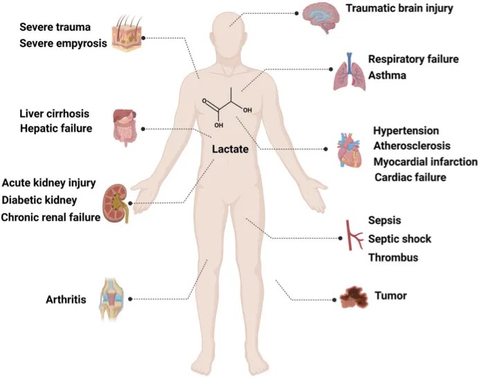 Graphic depicting the relationship between lactate, lactylation, and multiple diseases.