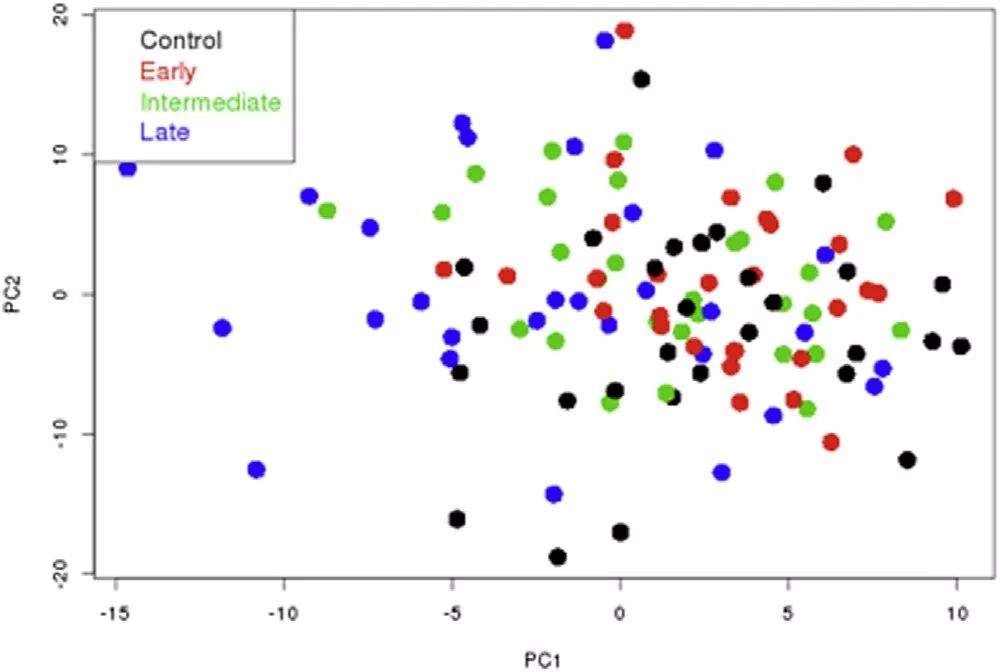 Metabolomics Fuels Discovery of Age-Related Macular Degeneration (AMD) Biomarkers