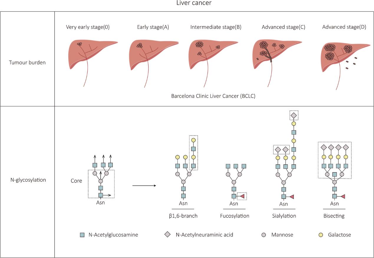 Schematic diagram of liver cancer progression and associated N-glycan type changes