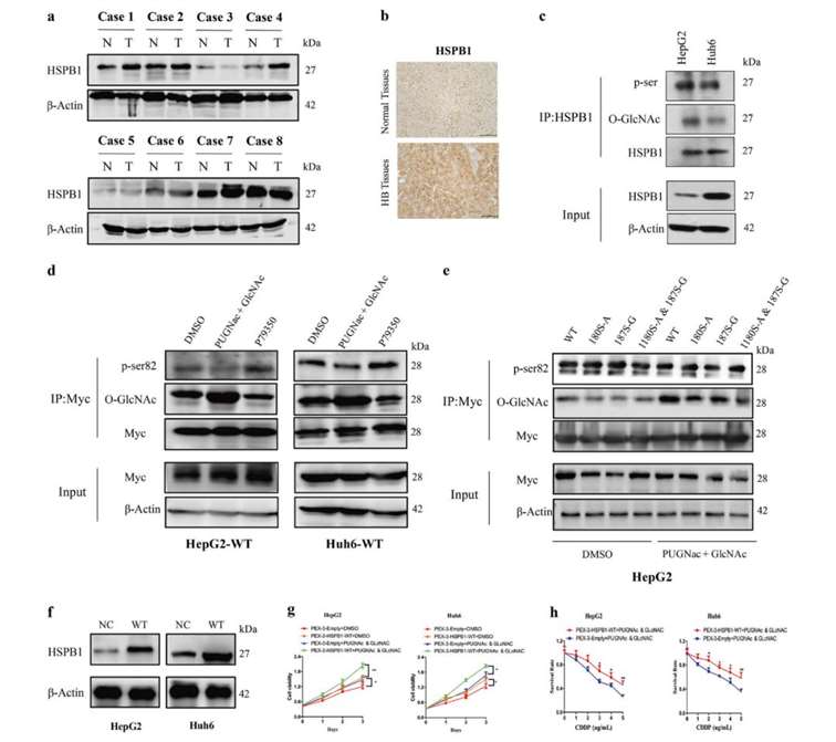 HSPB-1 protein O glycosylation modification affects drug resistance in HB cell lines