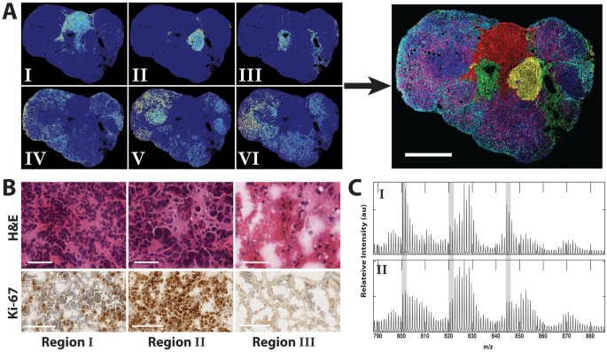 (A) Spatial distribution of clustered pixels for each K-means region attributed to the tumor phospholipids shown as individual images (left) and a merged overlay (right) with colors corresponding to the following regions: I-red, II-green, III-cyan, IV-yellow, V-blue, VI-purple.Scale bar, 5 mm. (B) H&E and Ki-67 stains corresponding to K-means regions I – III. Scale bars, 50 μm (H&E) and 100 μm (Ki-67). (C) Average spectra corresponding to K-means region I and II identified in the 2H-labeled tumor. Highlighted in gray are 3 areas that show different degrees of labeling for the same lipid between region I and II. This can be ascertained by visual inspection of the relative peak heights between adjacent peaks. 